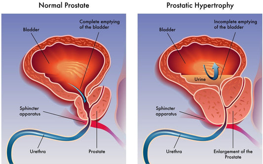 Shrink Your Enlarged Prostate Naturally with ProstaLite